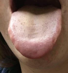 tongue 1 month after